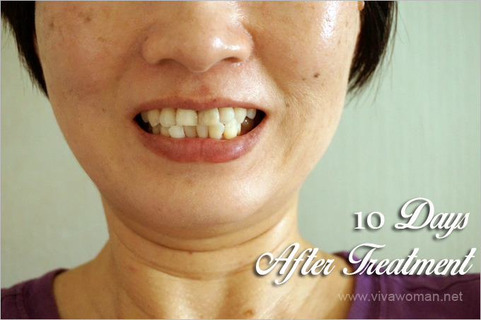 After-LED-Teeth-Whitening