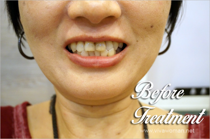 Before-LED-Teeth-Whitening